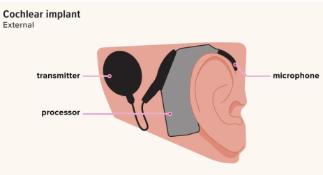 best-cochlear-implant-cochlear